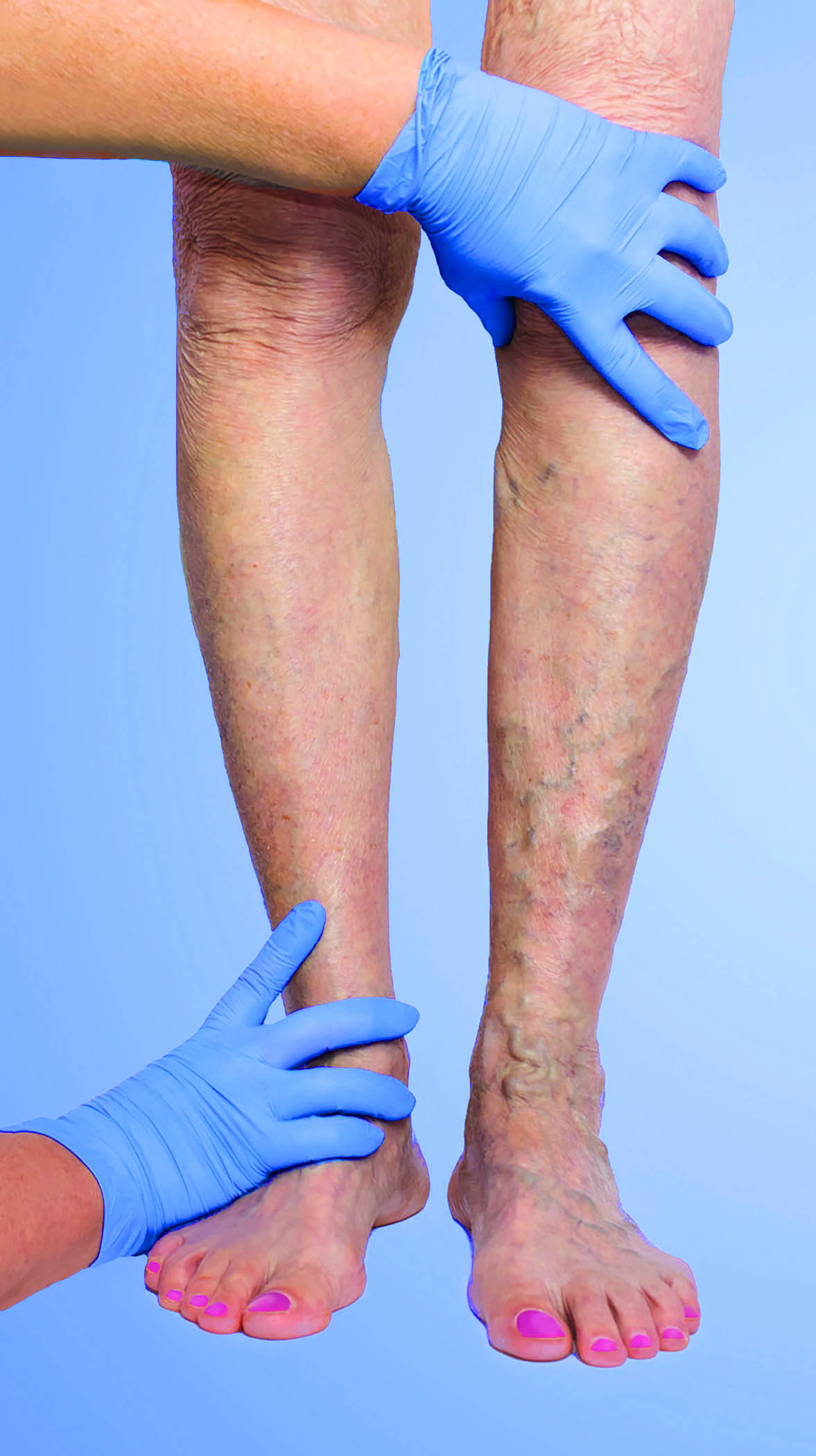 Varicose veins Varicose veins