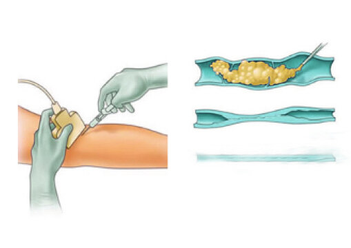Foam+sclerotherapy