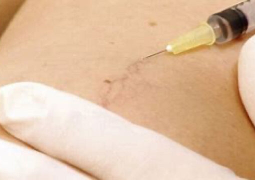 Micro+sclerotherapy